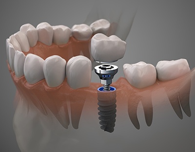a graphic illustration showing the different parts of a dental implant