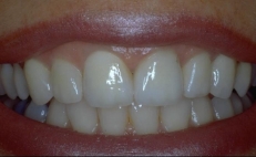 Close up of smile with whiter teeth