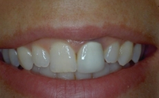 Close up of smile with slightly discolored teeth