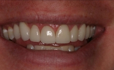 Close up of smile after fixing chipped and stained teeth