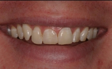 Close up of smile with a few chipped and stained teeth