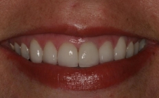 Close up of smile after gummy smile correction