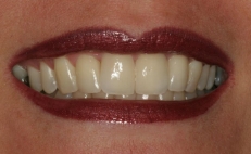 Close up of smile with red lipstick after dental work