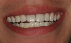 Close up of smile after correcting damaged and discolored teeth