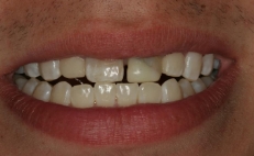 Close up of smile with damaged and discolored teeth