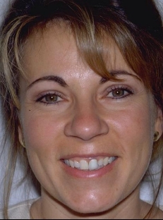 Woman smiling before dental treatment in Castle Rock