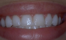 Close up of smile with whitened teeth