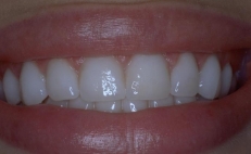 Close up of smile with whitened teeth