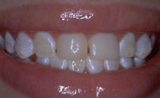 Close up of smile with slightly yellowed teeth