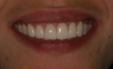 Close up of smile with no tooth stains