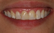 Close up of smile with a few yellow tooth stains