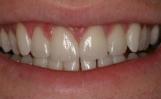 Close up of smile after fixing gapped teeth