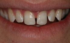Close up of smile with slightly gapped teeth