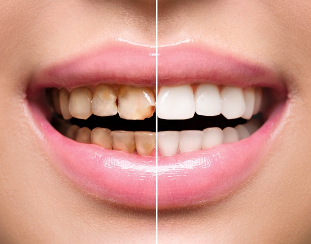 Close up of teeth before and after a smile makeover