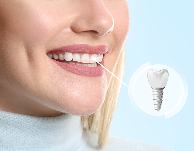Woman smiling with line between her tooth and illustration of dental implant