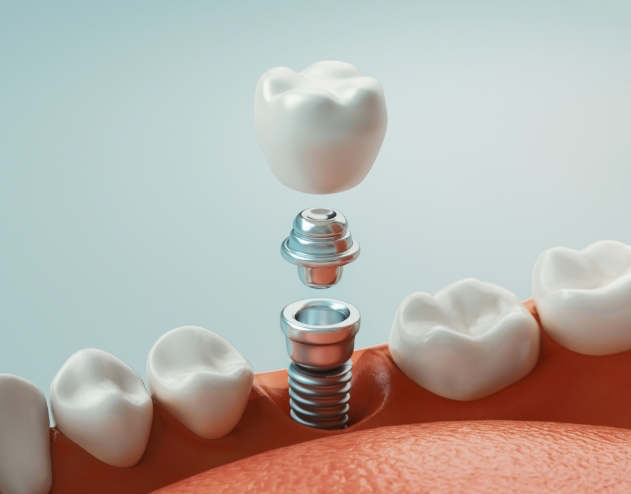 Illustrated dental implant replacing a missing tooth