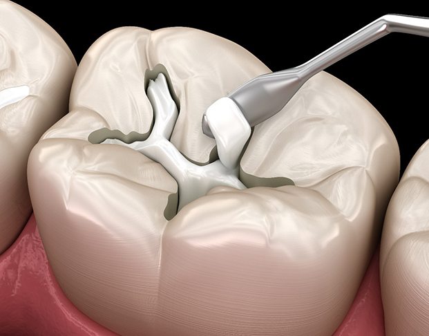 Illustration of composite resin being applied to cavity