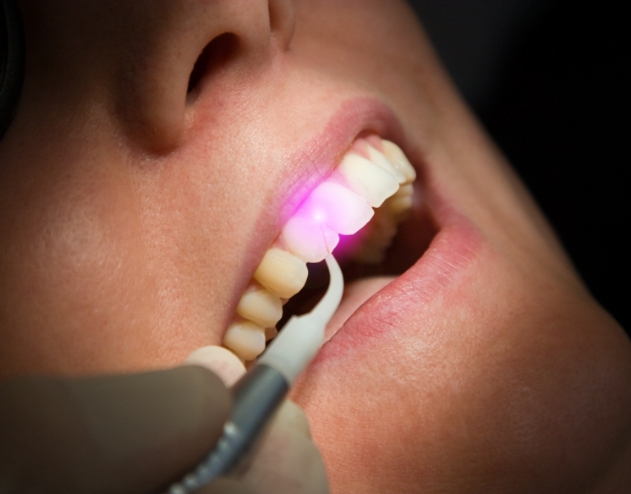 Close up of dentist using a dental laser to treat gum disease