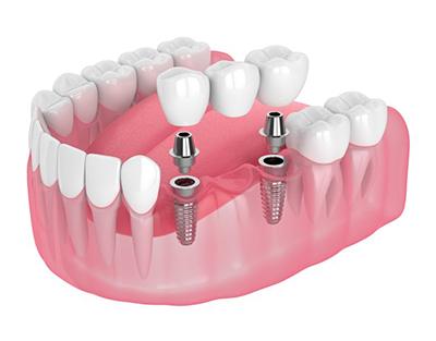 Exploded illustration of implant bridge with implants and abutment pieces