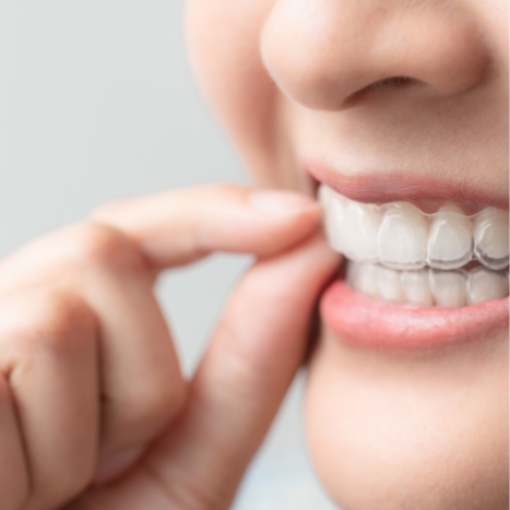 Close up of person putting Invisalign tray on their teeth