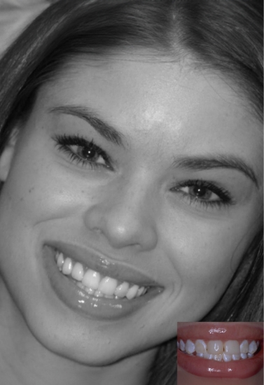Young woman with lip gloss grinning next to before photo of her smile