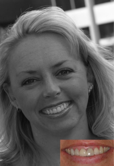 Blonde woman smiling next to photo of her teeth before dental work