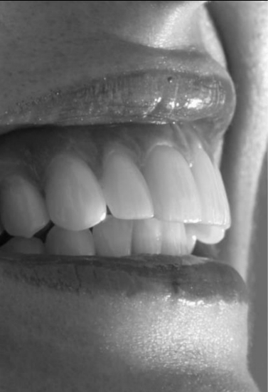 Close up side profile of teeth as a person smiles