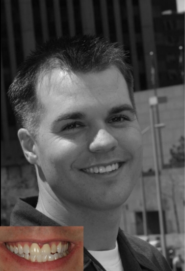 Man with short spiky hair grinning next to before photo of his smile