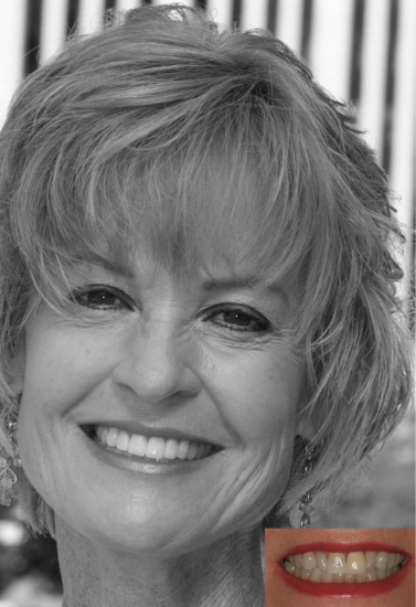 Older woman with short hair grinning next to before photo of her smile