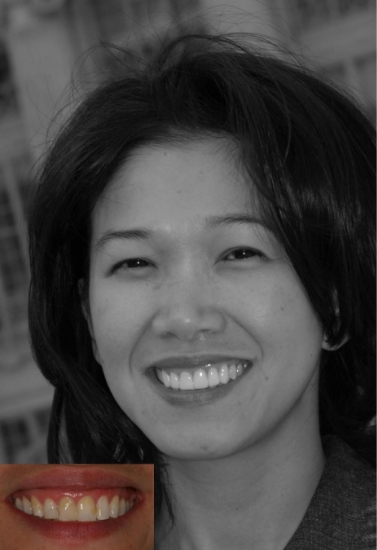 Woman with long dark hair smiling next to photo of her smile before treatment