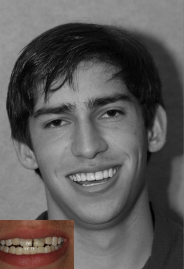 Young man grinning next to before photo of his smile