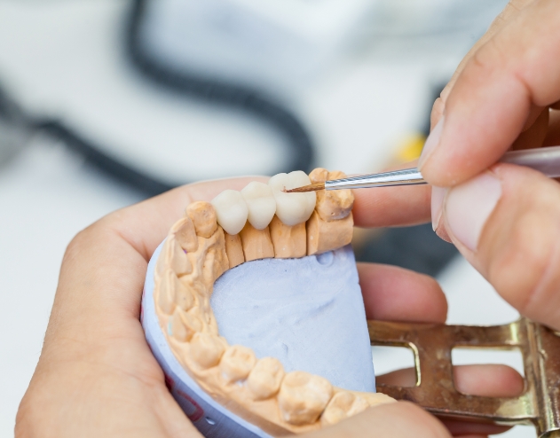 Dentist crafting a dental bridge in a model of the mouth