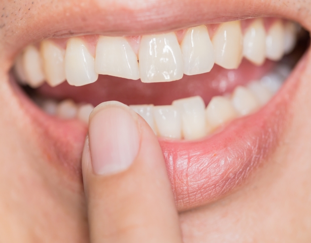 Close up of person pointing to their chipped tooth before restorative dentistry