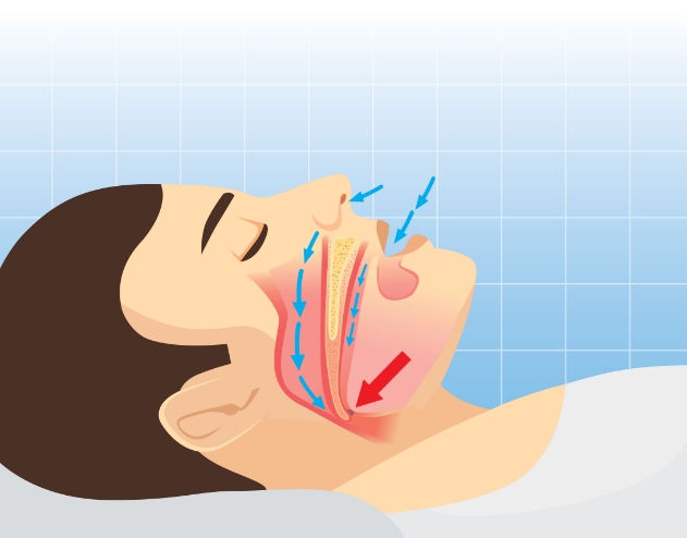 Illustrated person sleeping with diagram of their airway