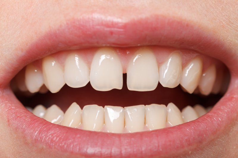 A closeup of a small gap between teeth